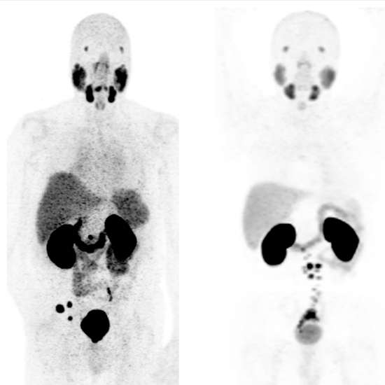 PSMA PET Scan, Preparation, Procedure, and the Requirements